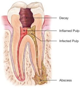 Infected-tooth-270x300